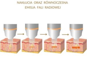 Radiofrekwencja mikroigłowa widok igieł - redukcja zmarszczek