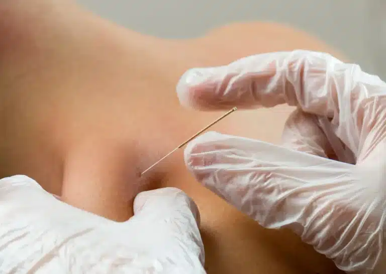 Fizjoterapeuta Holispace wykonujący zabieg igłoterapii suchej (dry needling) w terapii bólu mięśniowo-powięziowego