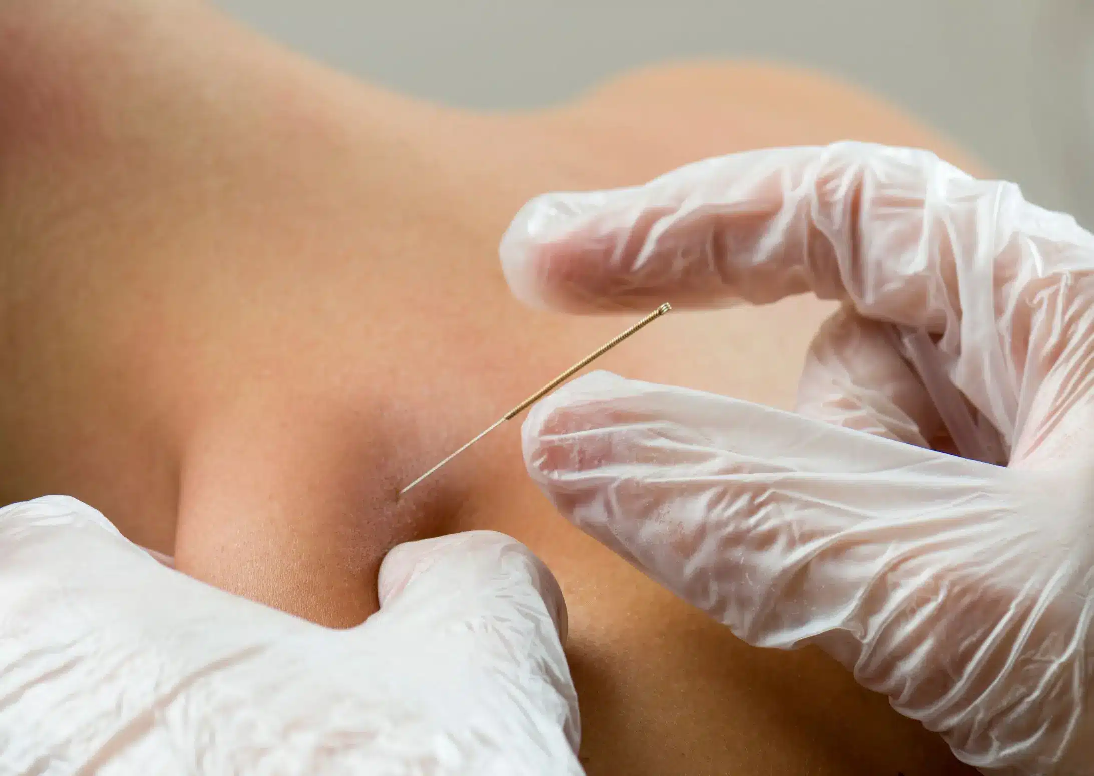 Fizjoterapeuta Holispace wykonujący zabieg igłoterapii suchej (dry needling) w terapii bólu mięśniowo-powięziowego